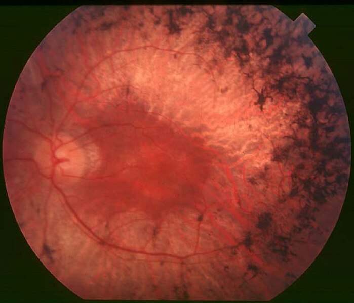 Fundus_of_patient_with_retinitis_pigmentosa,_mid_stage.jpg